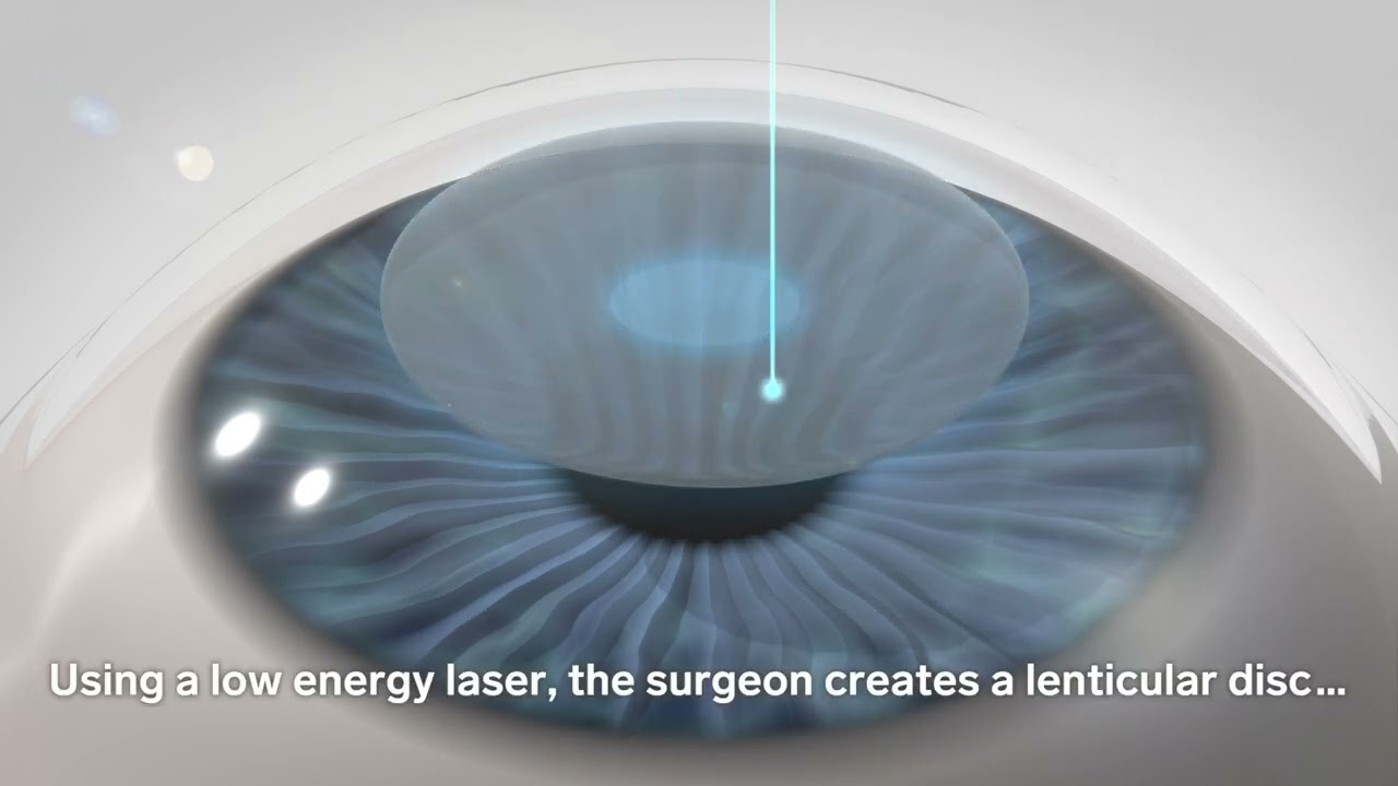 CLEAR - The Minimally Invasive Laser Vision Correction by Ziemer