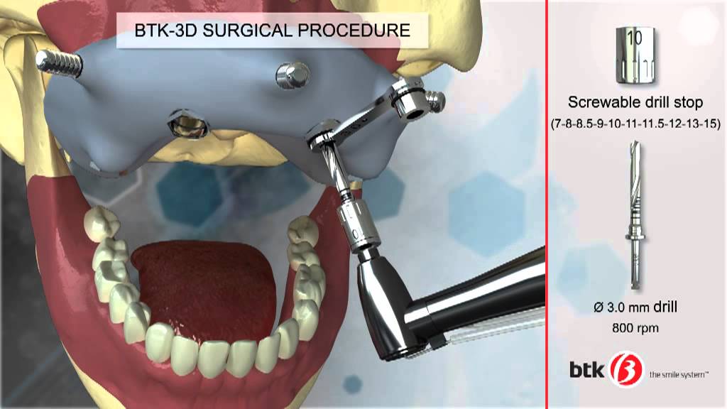 BTK The Smile System - Protocol Computer-Guided Surgery BTK-3D