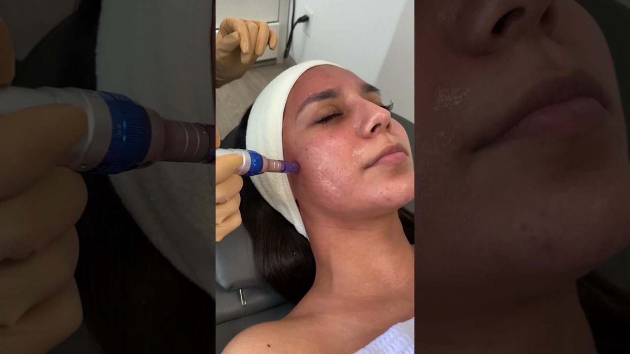 Microneedling 😮😬💉 | Evoclinic
