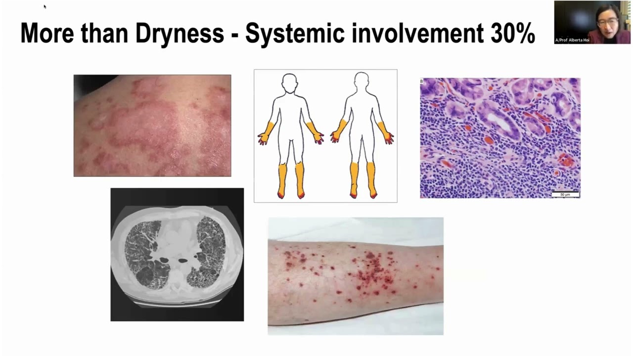 What is Sjogren’s disease and how is it managed?