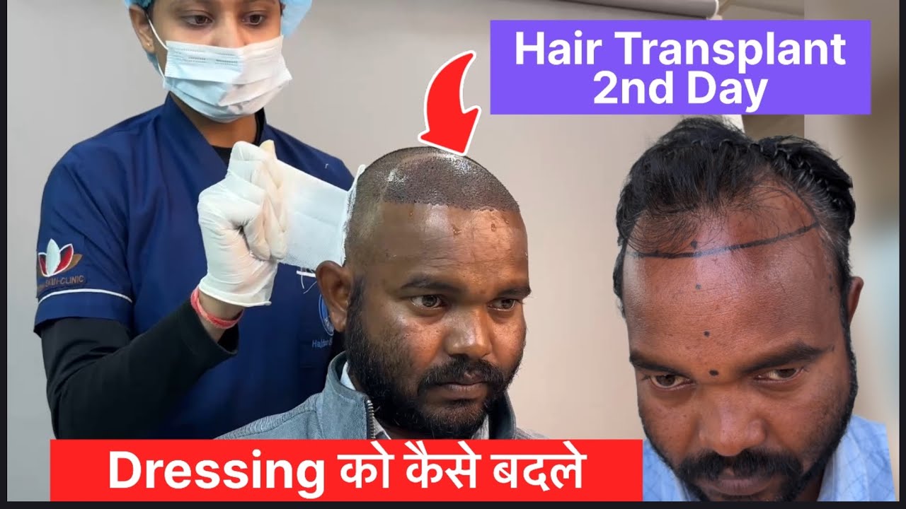 2nd Day Hair Transplant || पट्टी कैसे बदलें || bhopal 