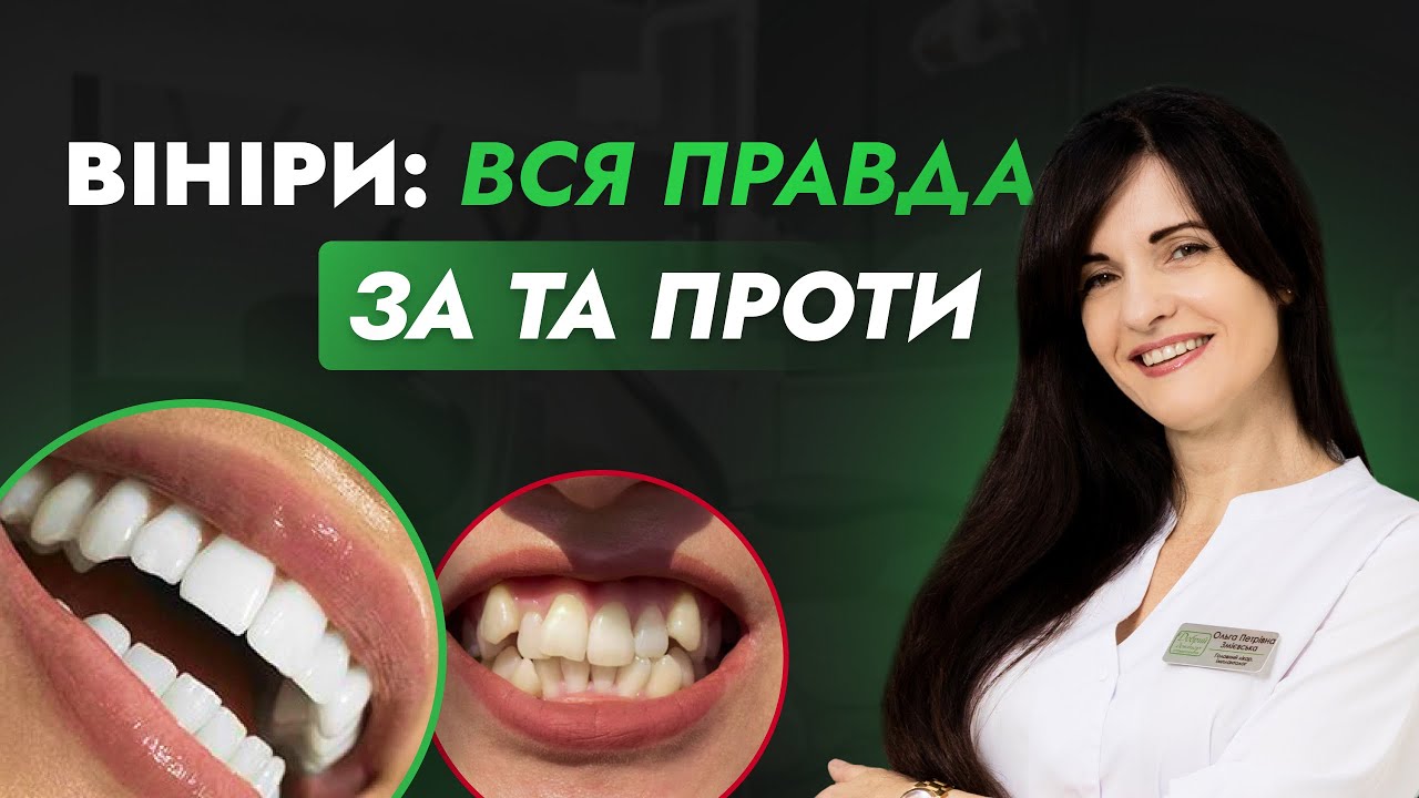 Як ставлять вініри: ціна та наслідки. Скільки коштують керамічні та композитні вініри на всі зуби