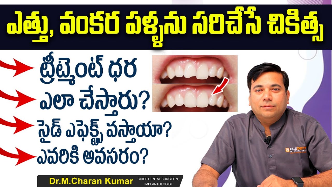ఎత్తు పళ్లకు పరిష్కారం | How to Fix Crooked Teeth? | Teeth Straightening Treatment Telugu | Eledent