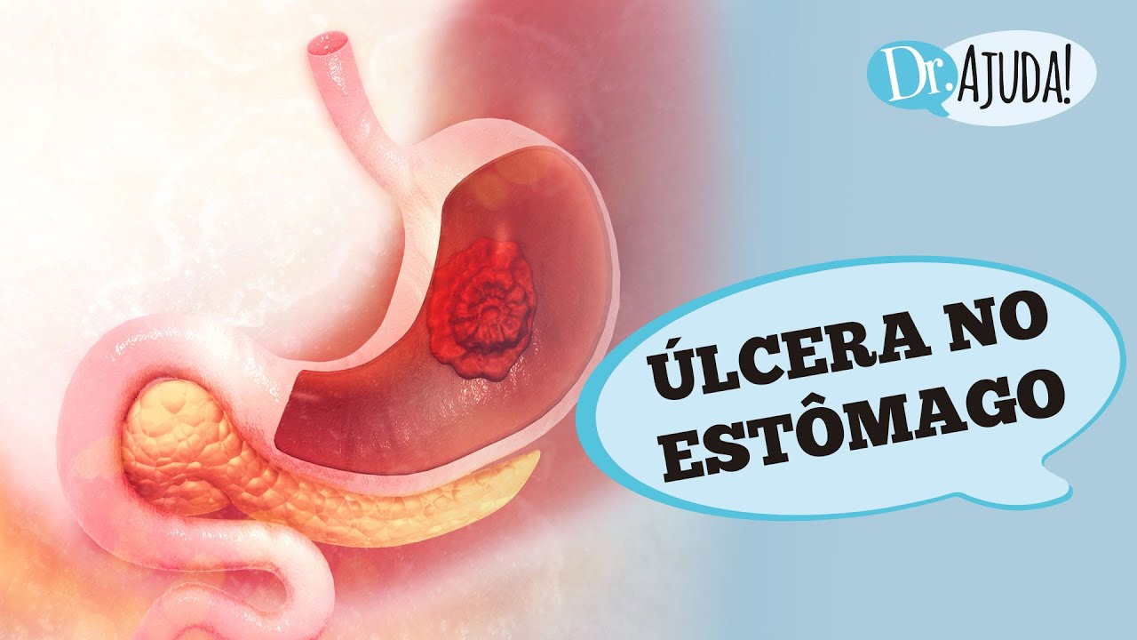 &Uacute;LCERA NO EST&Ocirc;MAGO E DUODENO: SINTOMAS, DIAGN&Oacute;STICO, TRATAMENTO E PREVEN&Ccedil;&Atilde;O