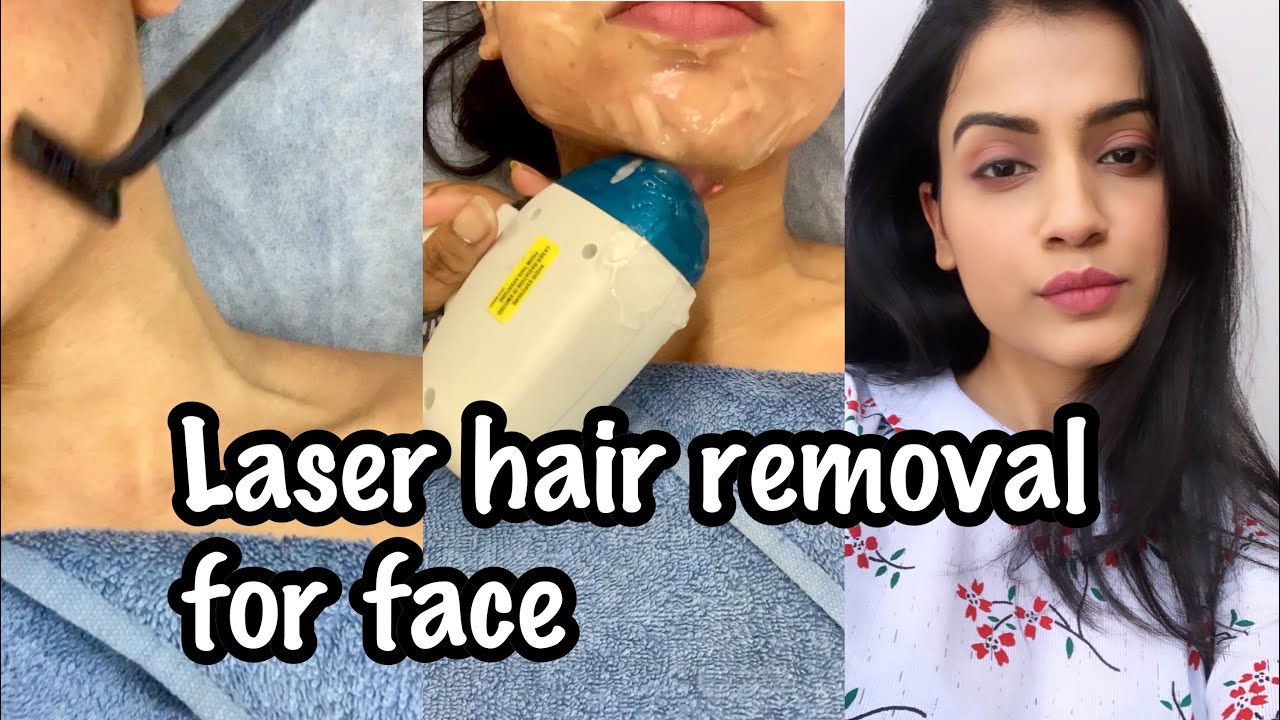 LASER HAIR REMOVAL FACE | My Experience of Facial Laser Hair Removal | Laser Hair Removal in India