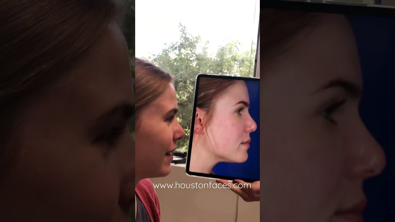 See The Results Of A Revision Rhinoplasty by Houston Nose Surgeon Dr. Michel Siegel!