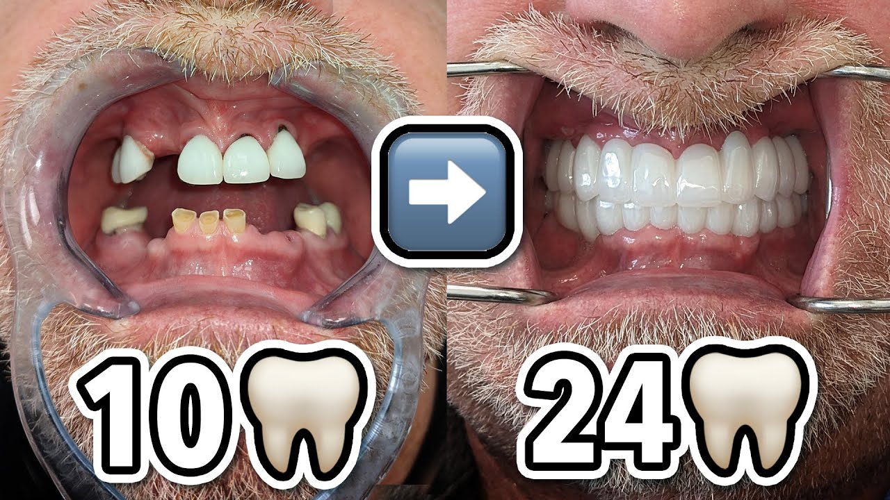 10 🦷 ➡️ 24 🦷: 10 teeth to 24 with 3 on 6 Dental Implant Bridges