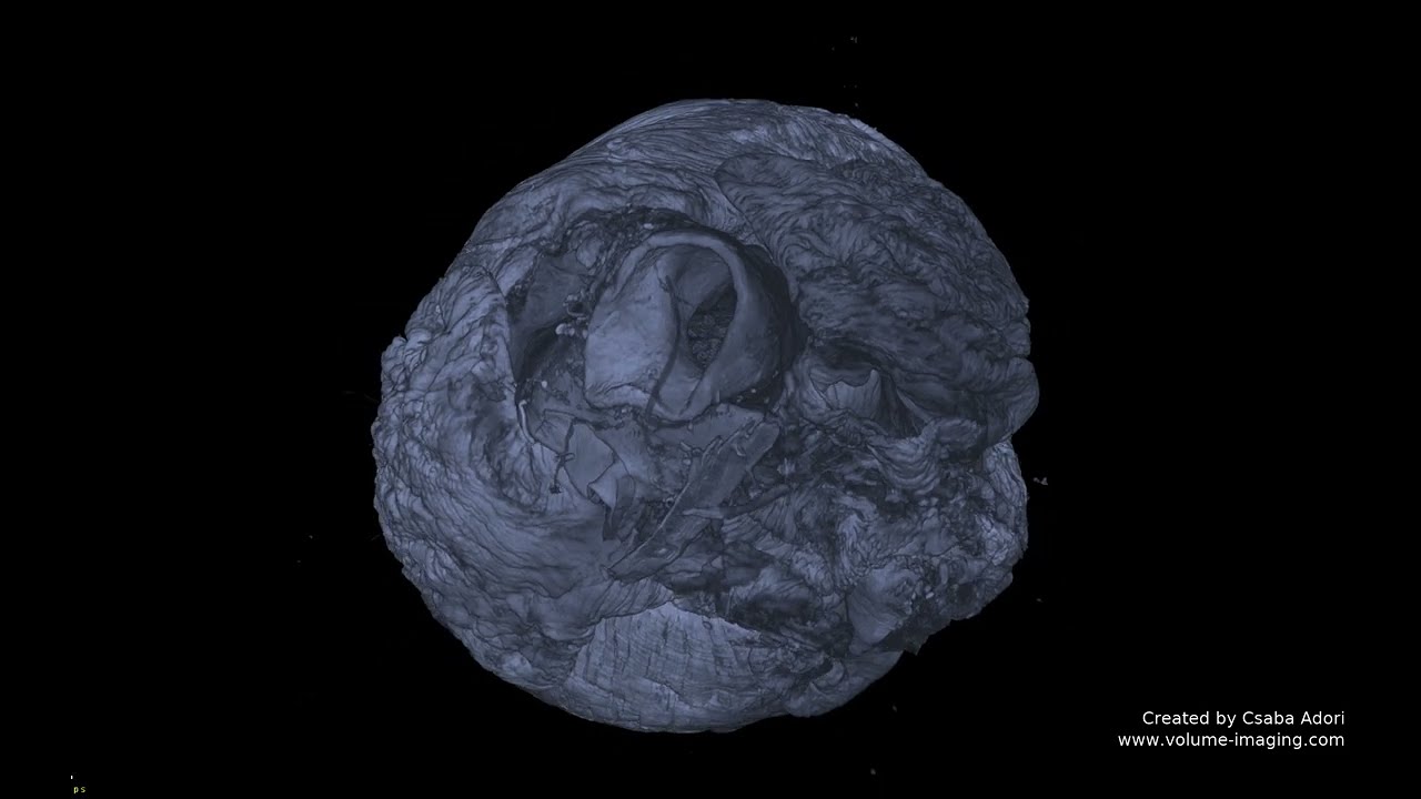 3D volume imaging - HEART MOVIE 2
