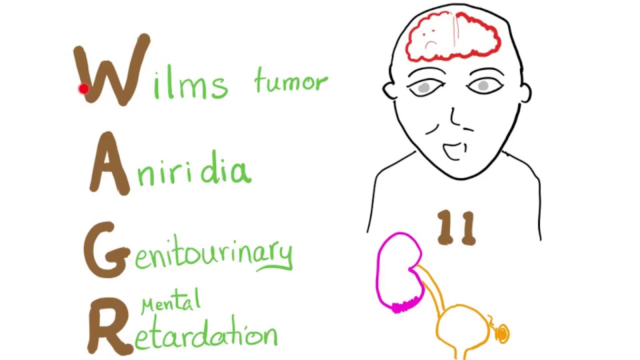 WAGR syndrome (Wilms tumor-aniridia syndrome) mnemonic!