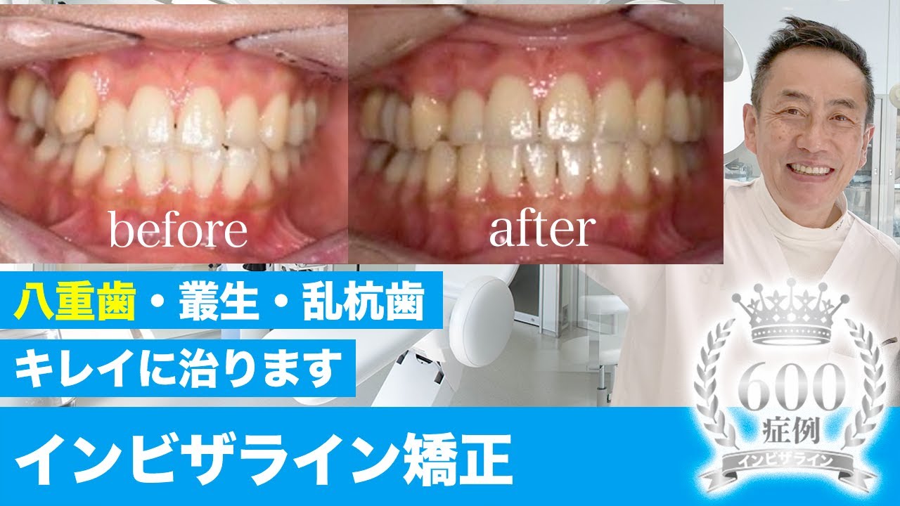 【抜歯矯正①八重歯／叢生(そうせい)／乱杭歯 】八重歯はキレイに治ります。症例紹介(インビザライン)