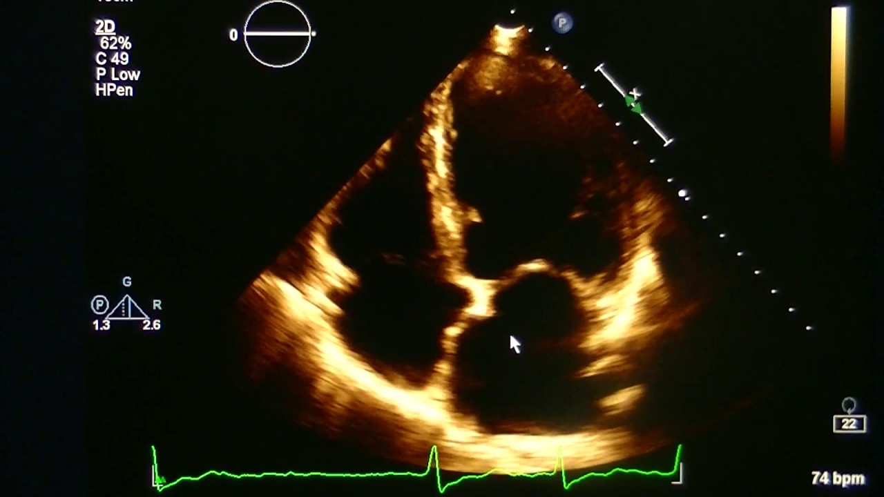 Echocardiogram With Atrial Fibrillation: Practice Visual Estimation Ejection Fraction: