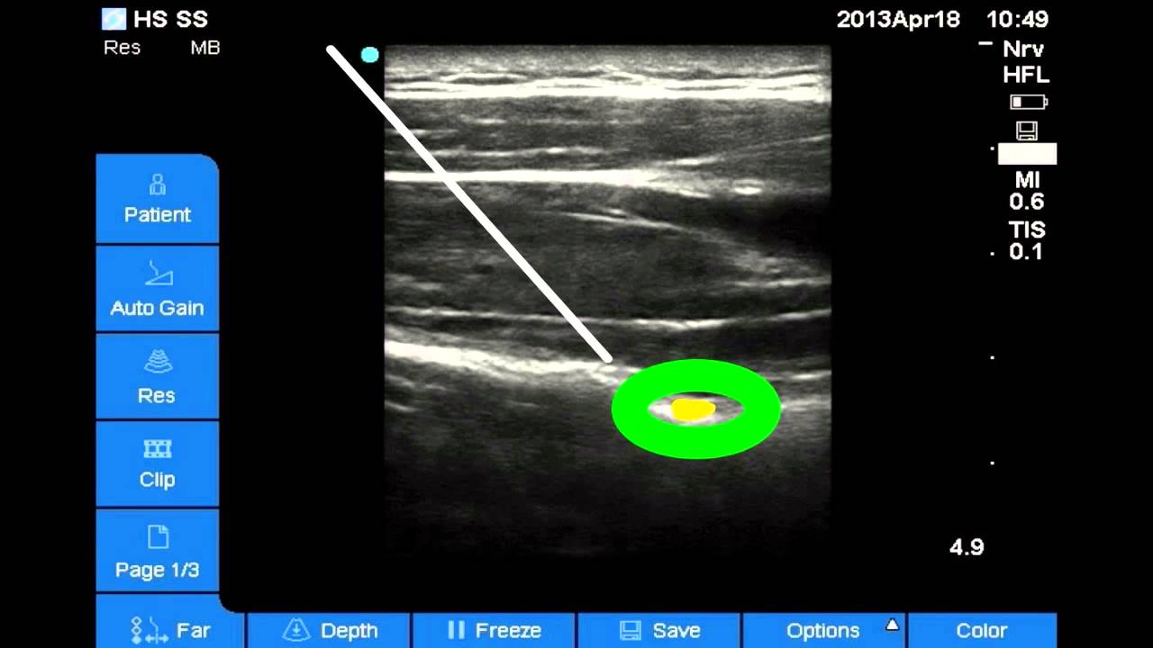 Shoulder Block: Part 3 of 3