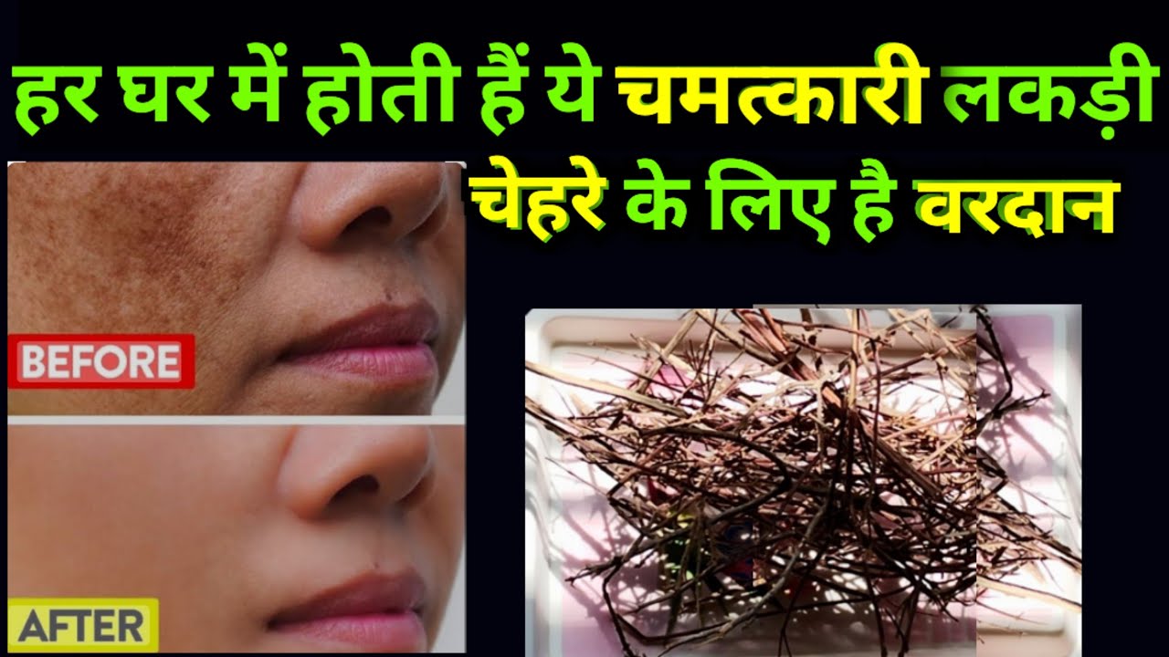 how to get rid of hyperpigmentation : तुलसी की सूखी लकड़ी से facial किया और ये क्या हो गया !