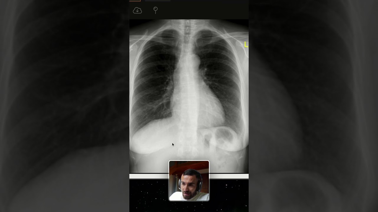 Trouve le diagnostic en radiographie de thorax 🩻￼