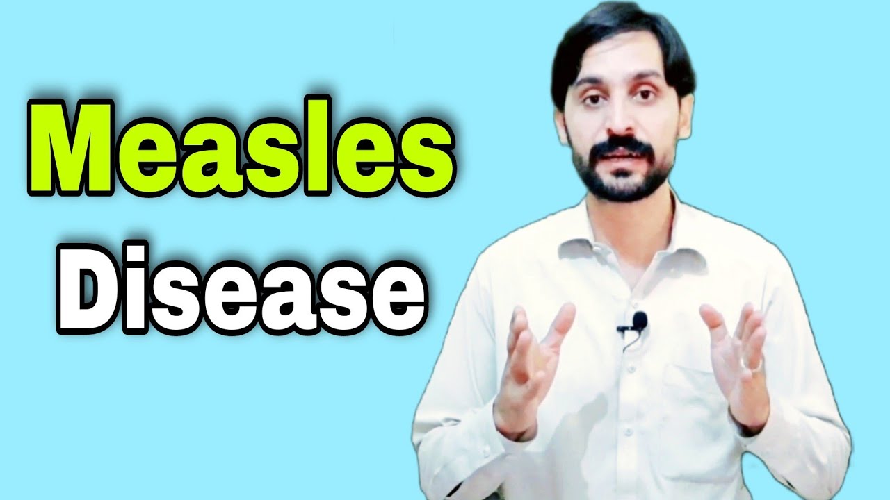 Measles Disease | Measles Virus | Causes | Symptoms | Treatment and Transmission