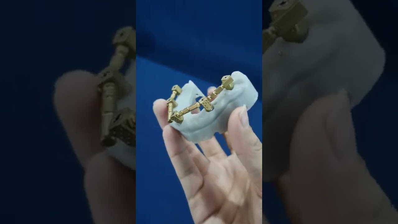 scanbody for edentulous case