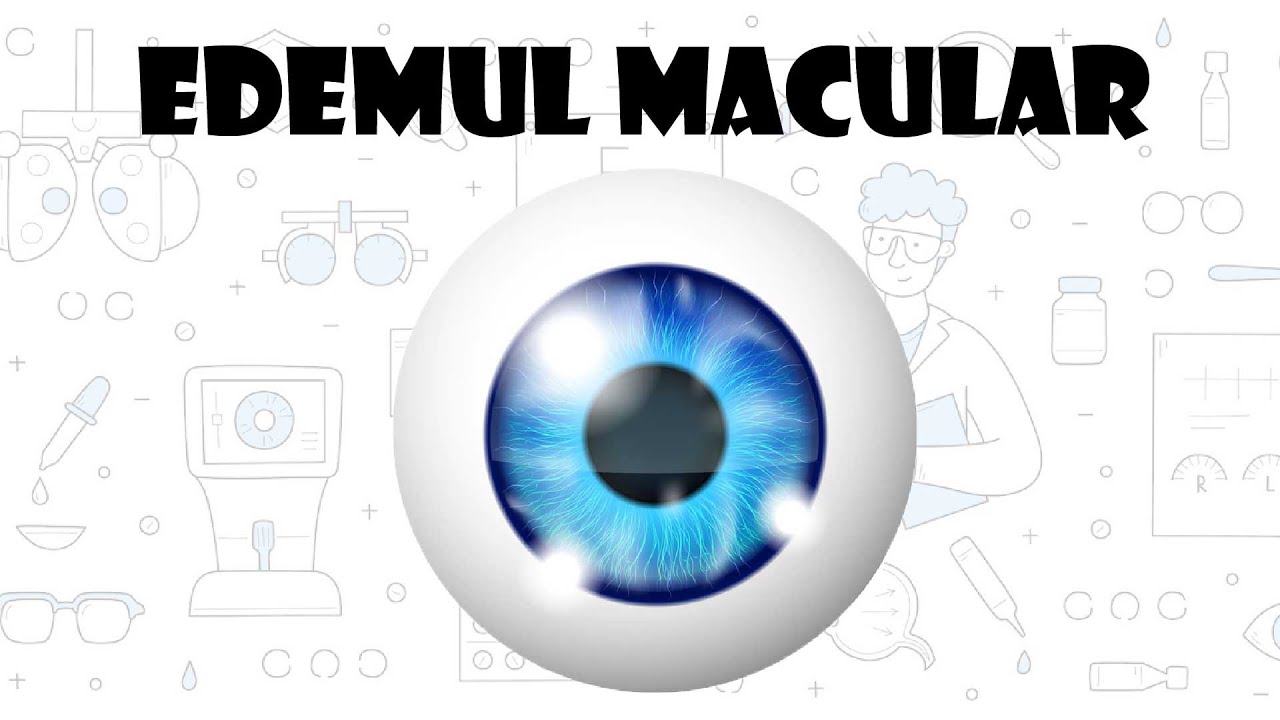 Ce inseamna Edemul Macular? Grila Amsler