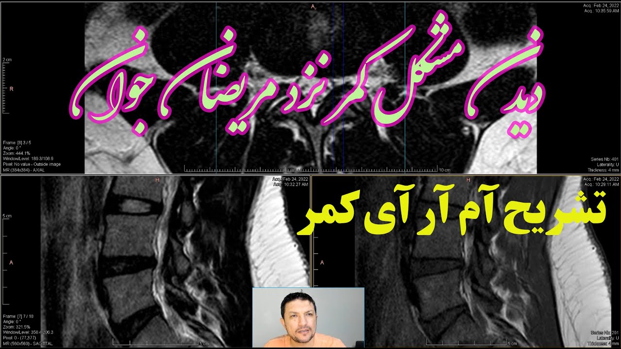 تشریح ام آر کمر در نزد مریضی با درد کمر و انتشار به پا Lumbar #MRI in patient with #disc #protrusion