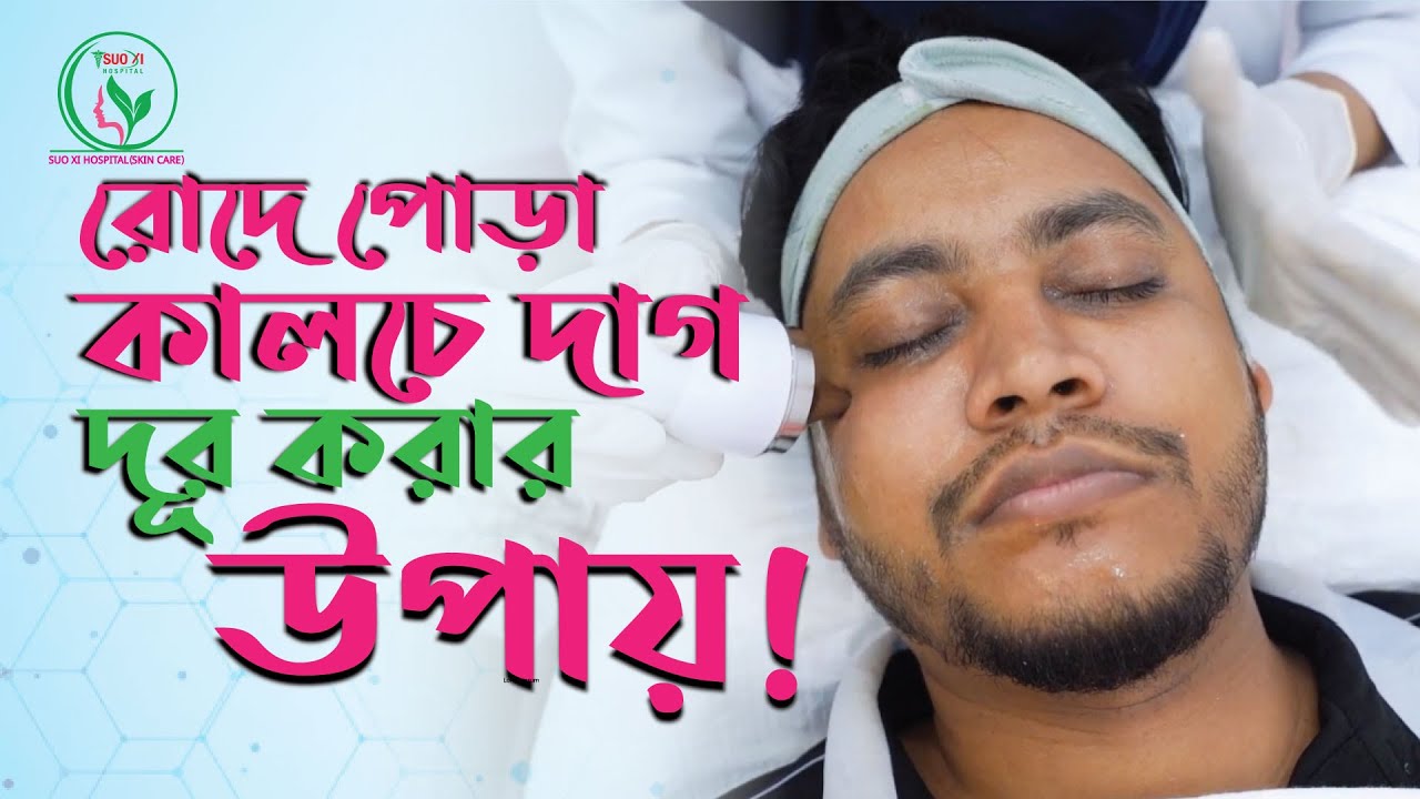 মুখে রোদে পড়া কালচে দাগ? দেখুন রোদে পোড়া কালচে দাগ দূর করার উপায় ! How to remove suntan in winter