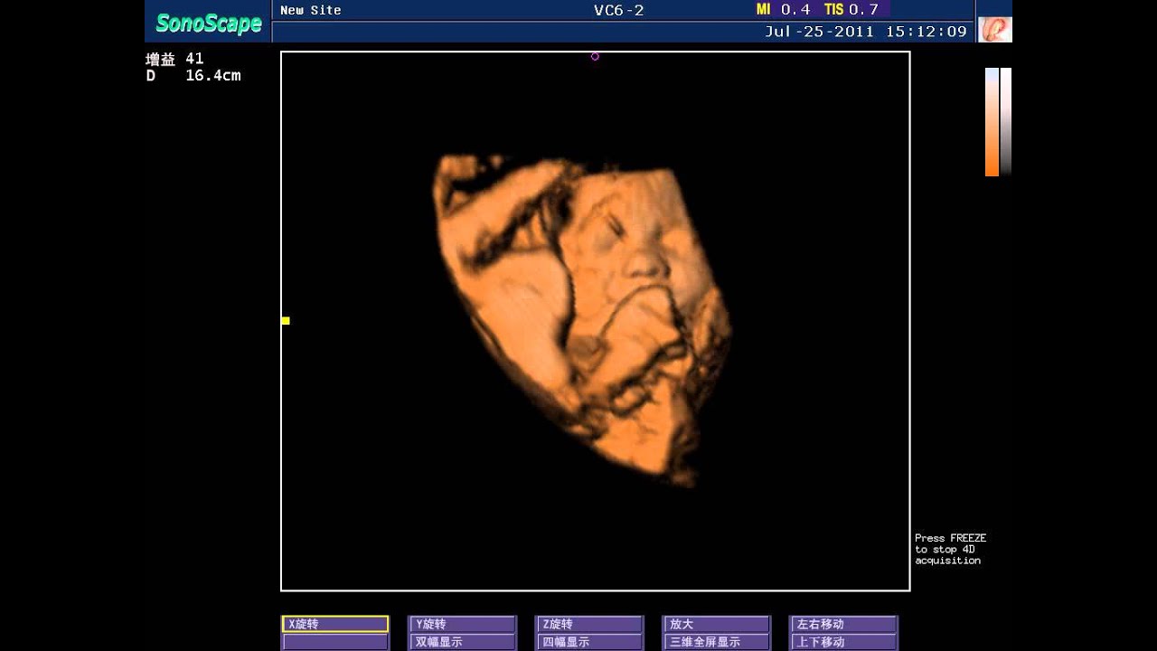 Ultrasonografia dopplerowska Sonoscape S8 | Demo funkcji 4D