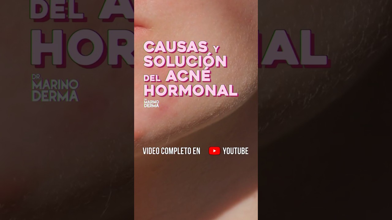 ✨&iexcl;Este Domingo, no te pierdas! CAUSAS Y SOLUCI&Oacute;N DEL ACN&Eacute; HORMONAL.✨ Por este canal 7:15pm