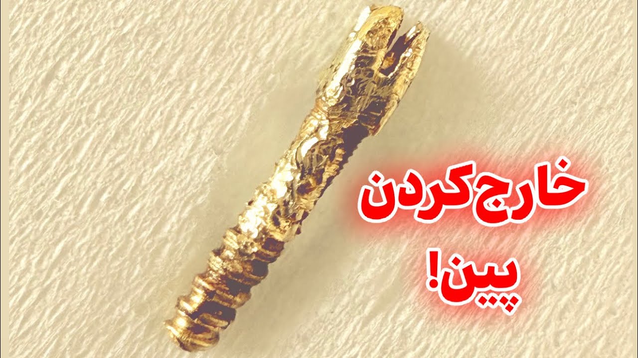 آموزش خارج‌کردن پین (پست پره‌فبریکیتد) از دندان اندو شده
