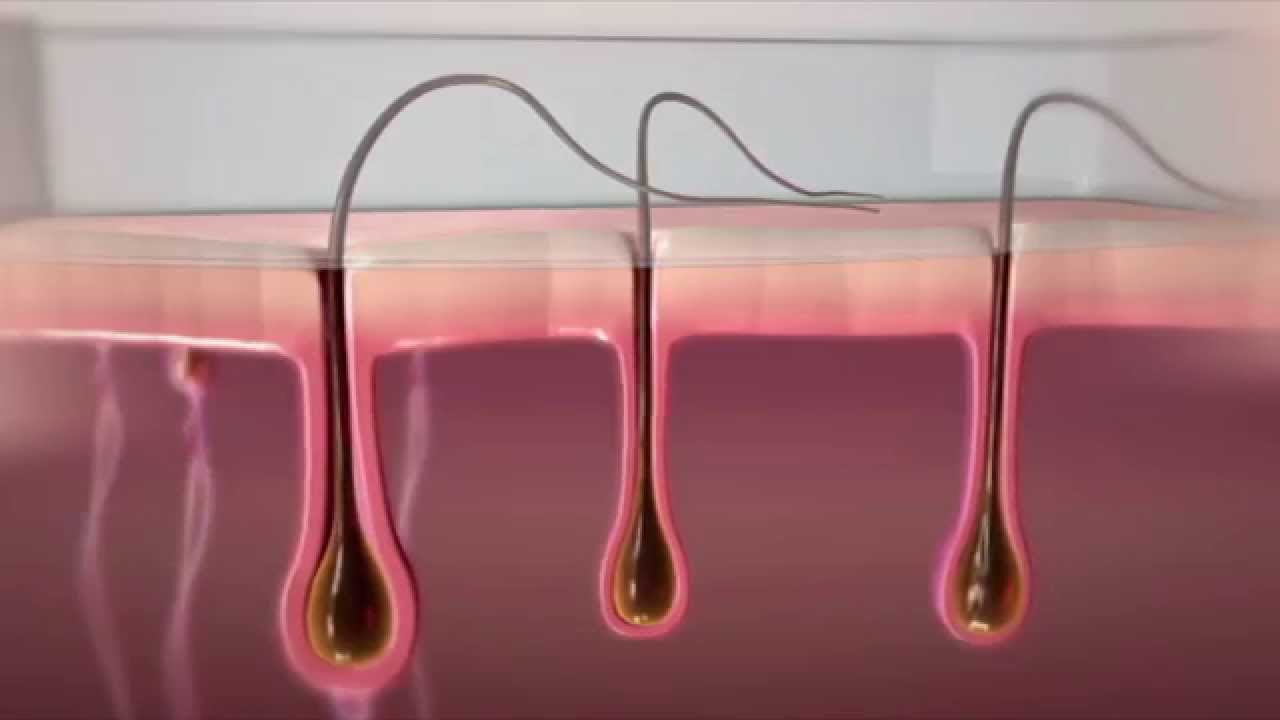 Wie funktioniert HPL Haarentfernung auf Lichtbasis & was sind die Vorteile zur Laser / IPL Methode.