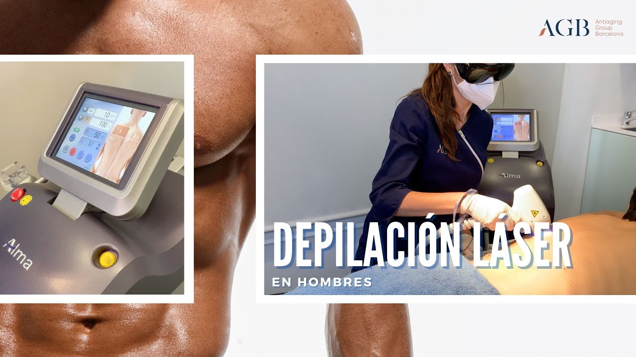 Depilación Láser en Hombres