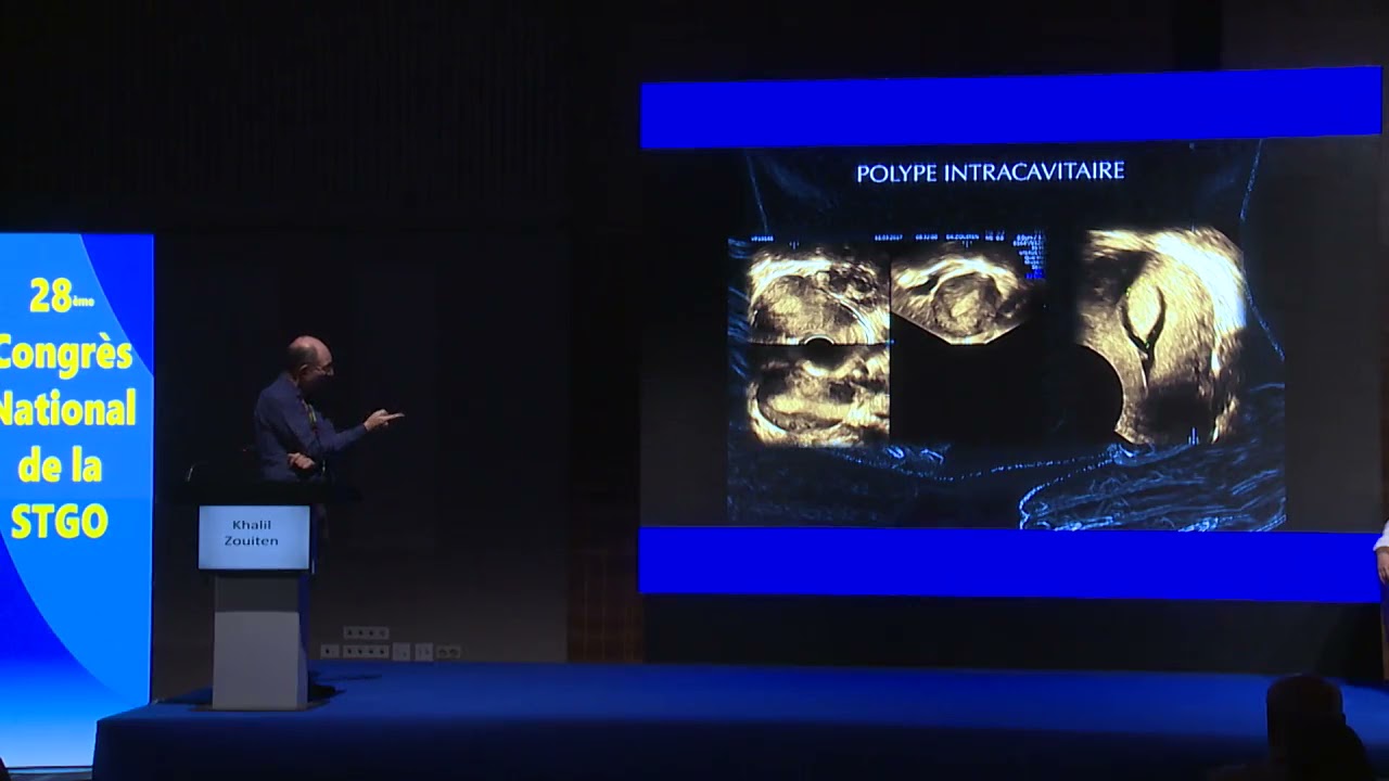 28 ème Congrès de la STGO:Dr Khalil zwiten: L'hysterosonographie