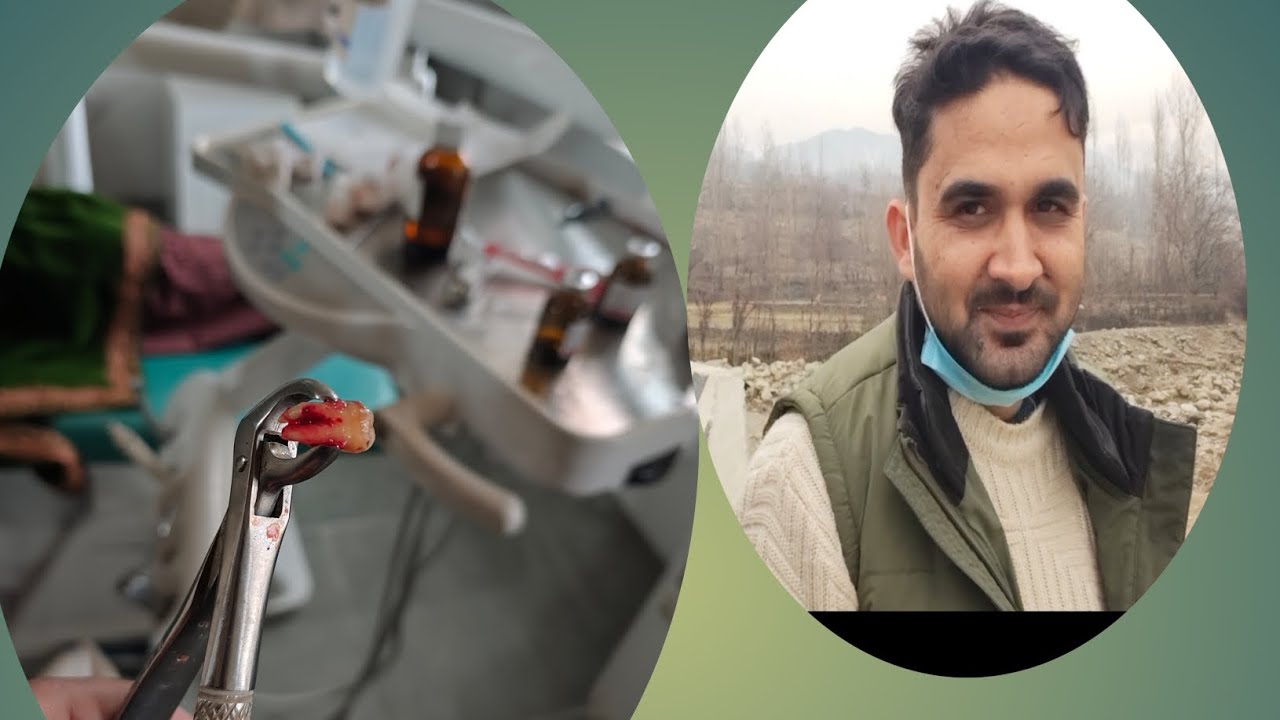 TOOTH EXTRACTION 😍