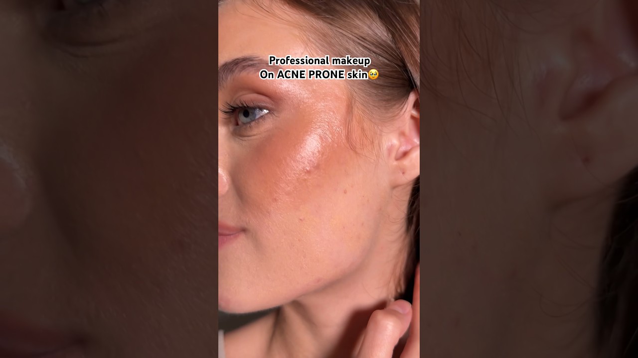 Models aren&rsquo;t perfect 🥹💖#acne #acnetreatment #acnetips #skincare
