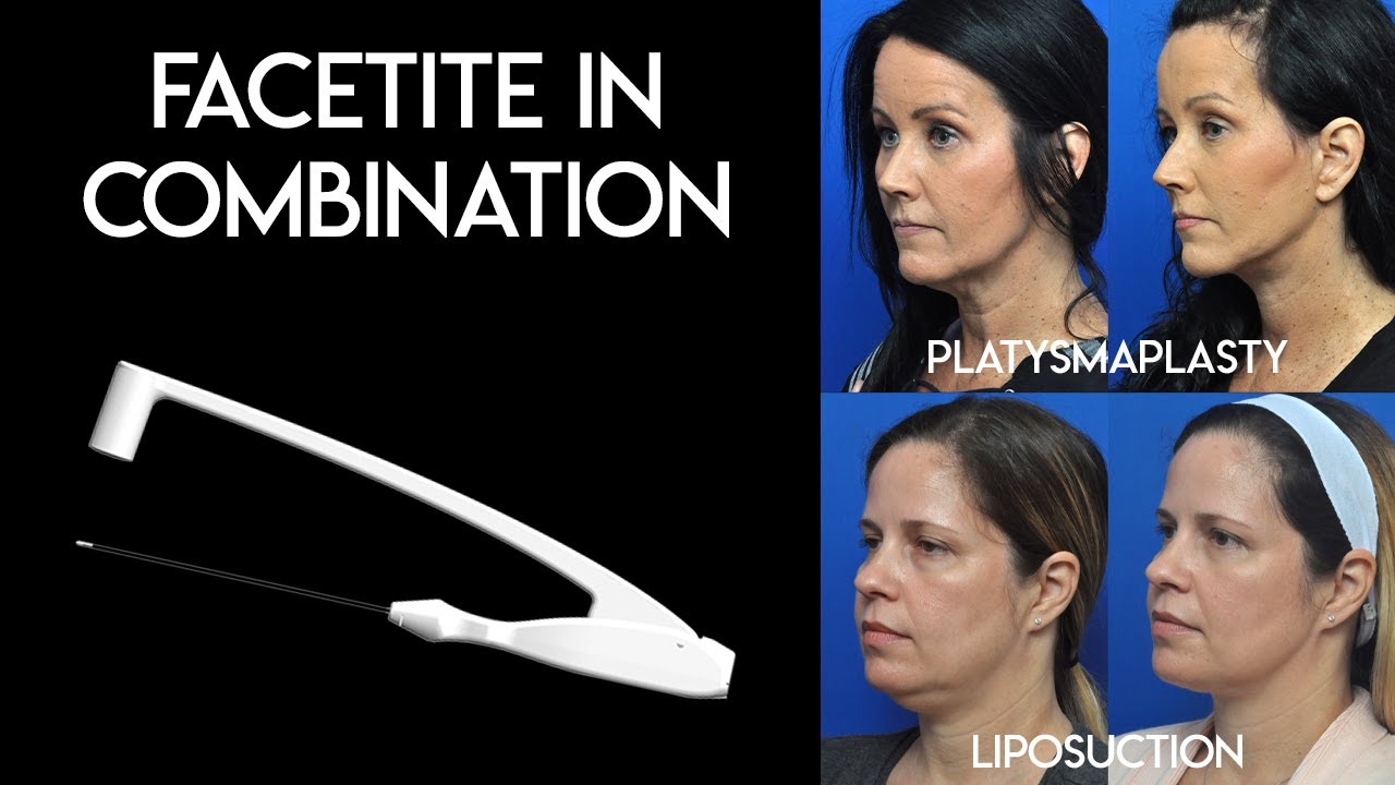 Facetite in Combination