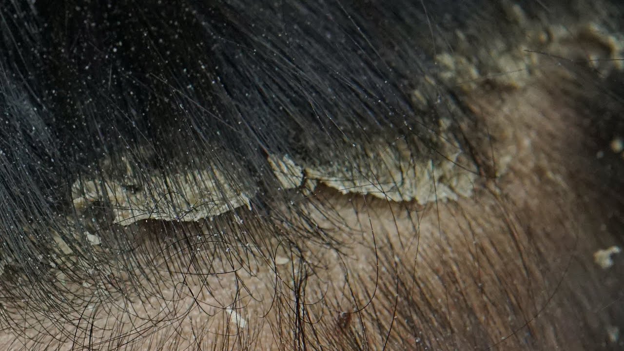 ASMR Satisfying Dandruff Treatment & Scalp Check #35