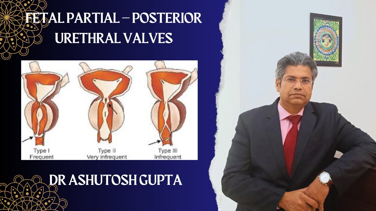 Fetal Partial &ndash; Posterior urethral valves