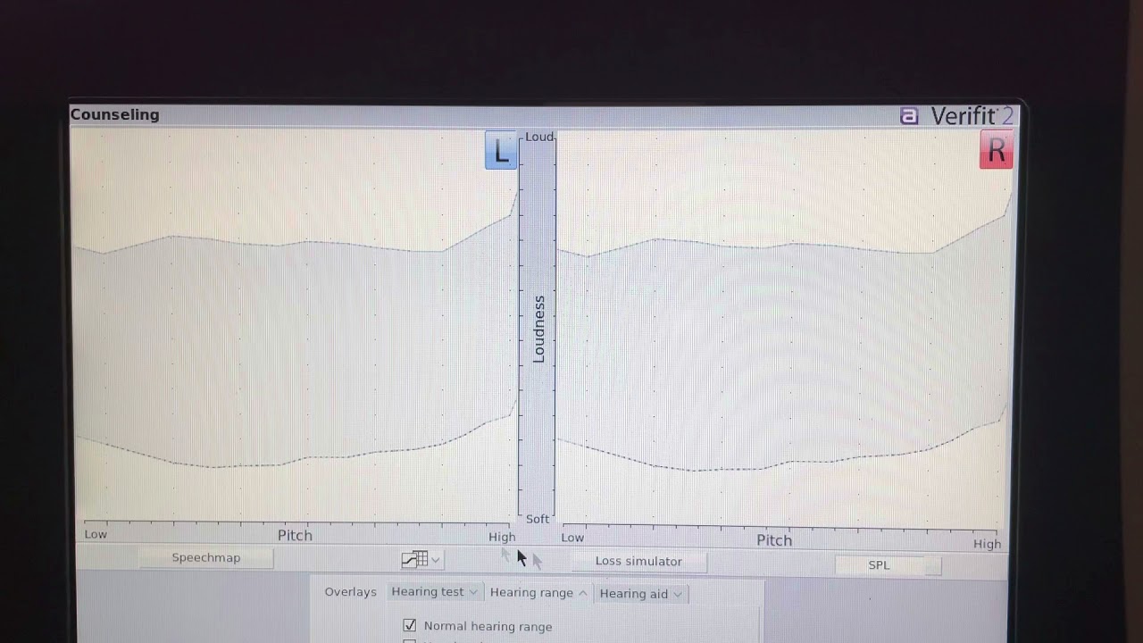 Cookie bite hearing loss simulation