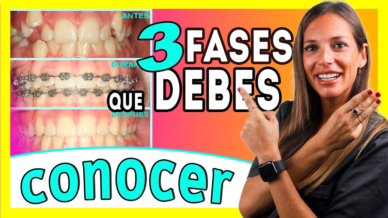 (Brackets proceso 𝗠𝗘𝗦 𝗮 𝗠𝗘𝗦 📆) Las ③ 𝐄𝐓𝐀𝐏𝐀𝐒 del TRATAMIENTO de Ortodoncia - Te lo explico ✅ＦÁＣＩＬ