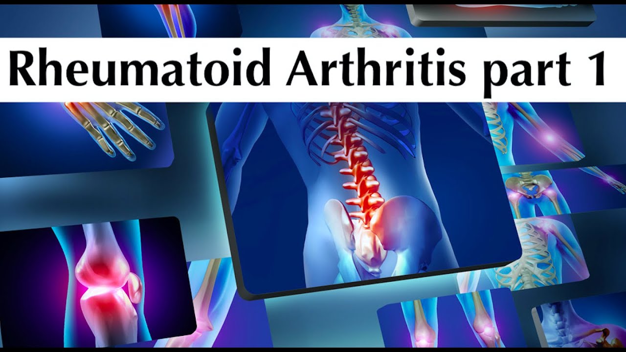 Rheumatoid arthritis part 1 by ASM Minds Team