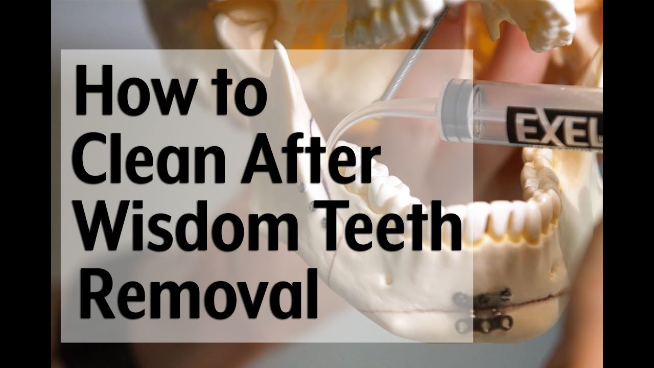Post-op video instruction: How to clean with a syringe after wisdom teeth removal