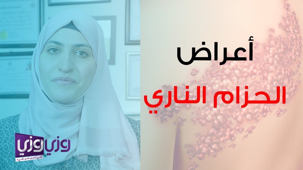 أعراض الحزام الناري وعلاجه
