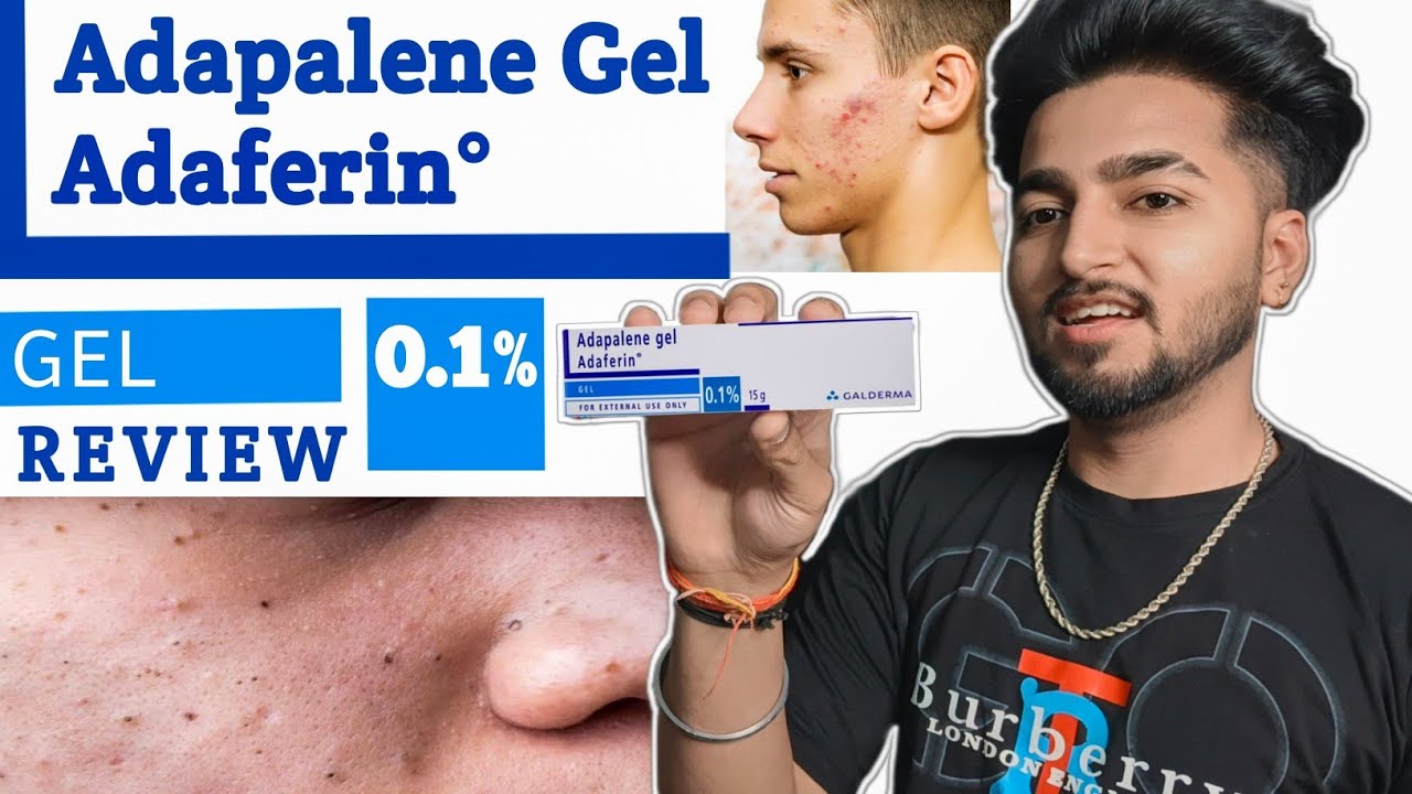 Adapalene Gel Adaferin 0.1% Review In Hindi | Best Gel For Removing Blackheads and Whiteheads