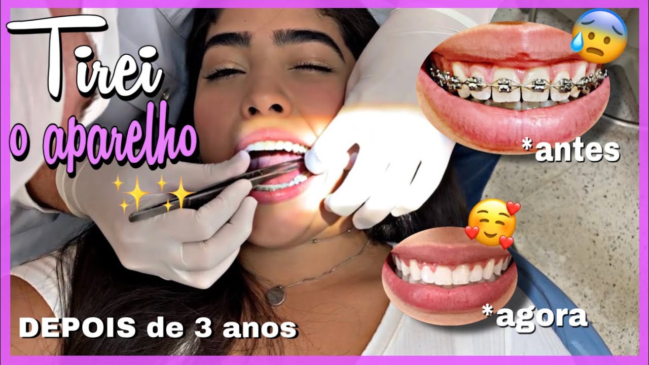 TIREI O APARELHO E COLOQUEI A CONTENÇÃO ✨| vlog