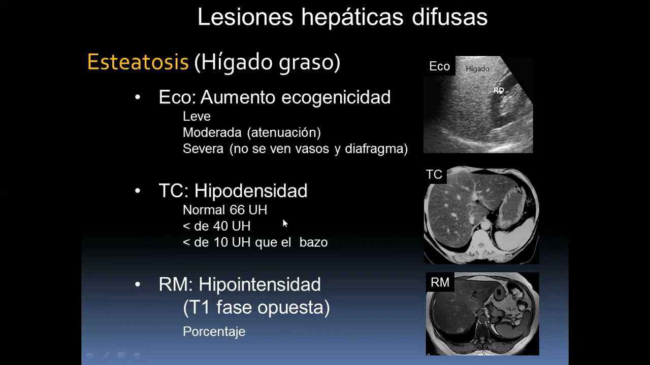 Diagnóstico por Imágenes: Ecografía, Tomografía y Resonancia en Hepatología y Pancreatología