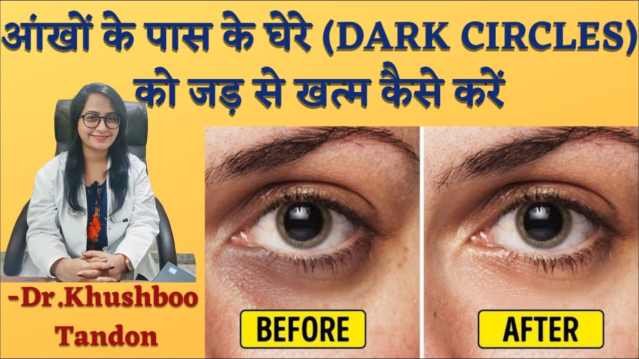 How To Get Rid Of Dark Circle (In Hindi) || By Dr. Khushboo Tandon