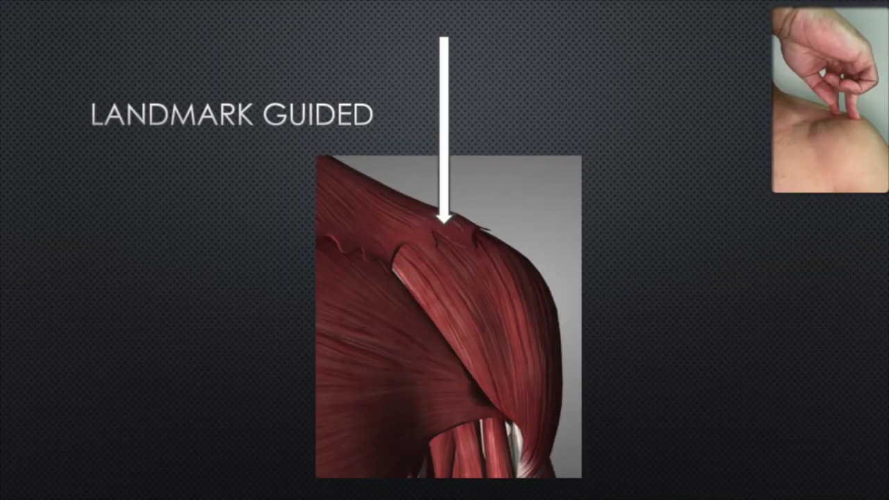 ACJoint Injection Technique