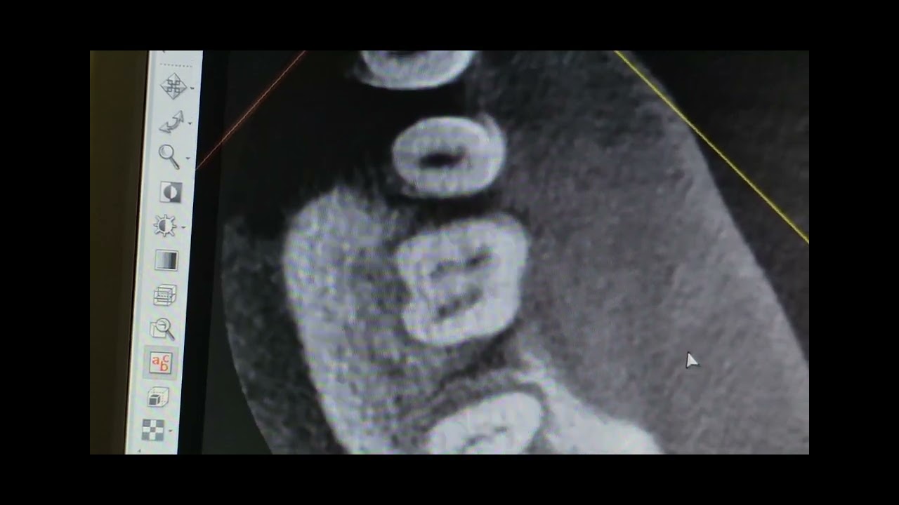 @صورة cbct تحول حالة معالجة جذور من فشل إلى نجاح