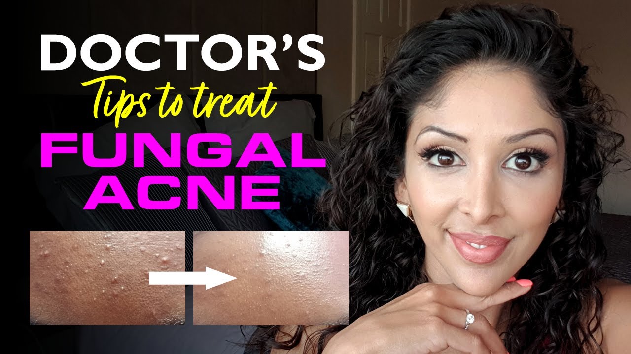 FUNGAL ACNE by DOCTOR V| Brown/ Dark skin of colour| SOC | Nizoral, bumpy skin, clear skin, acne