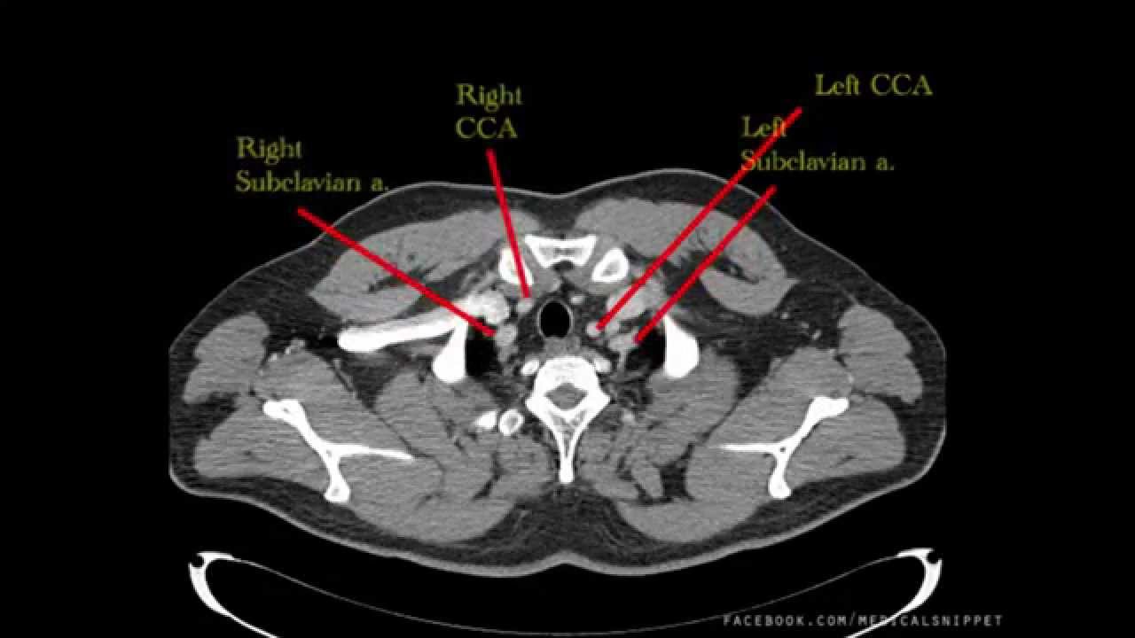 Major Thoracic Vessels | Arteries