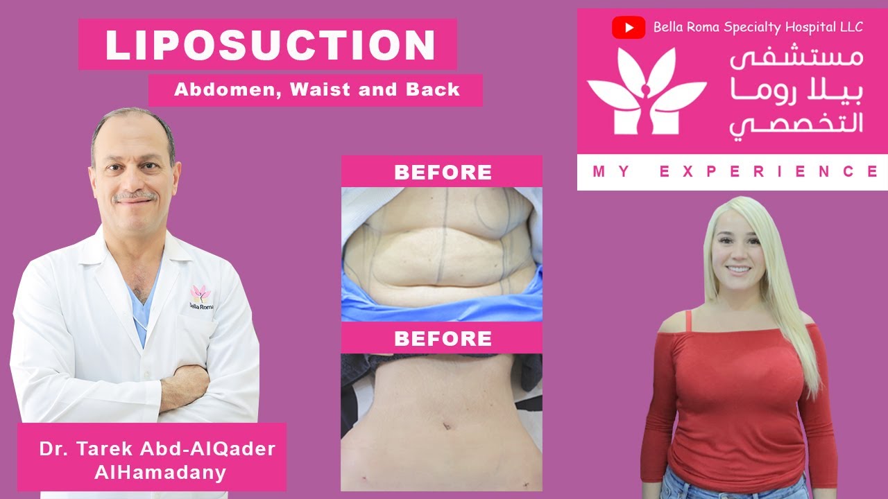 Liposuction of Abdoment Waist and Back in Bella Roma Dubai