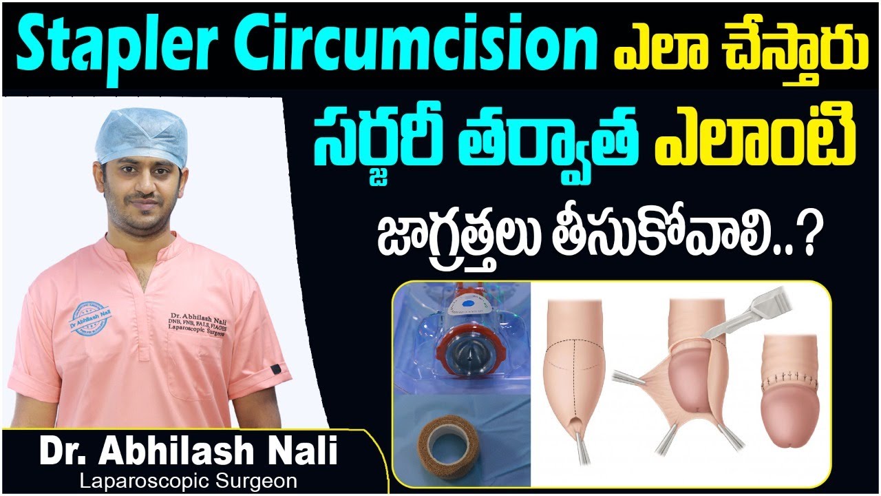 స్టాప్లర్ తో లాభాలు ఇవే | Benefits & Post Operative Care of Stapler Circumcision | Dr Abhilash Nali