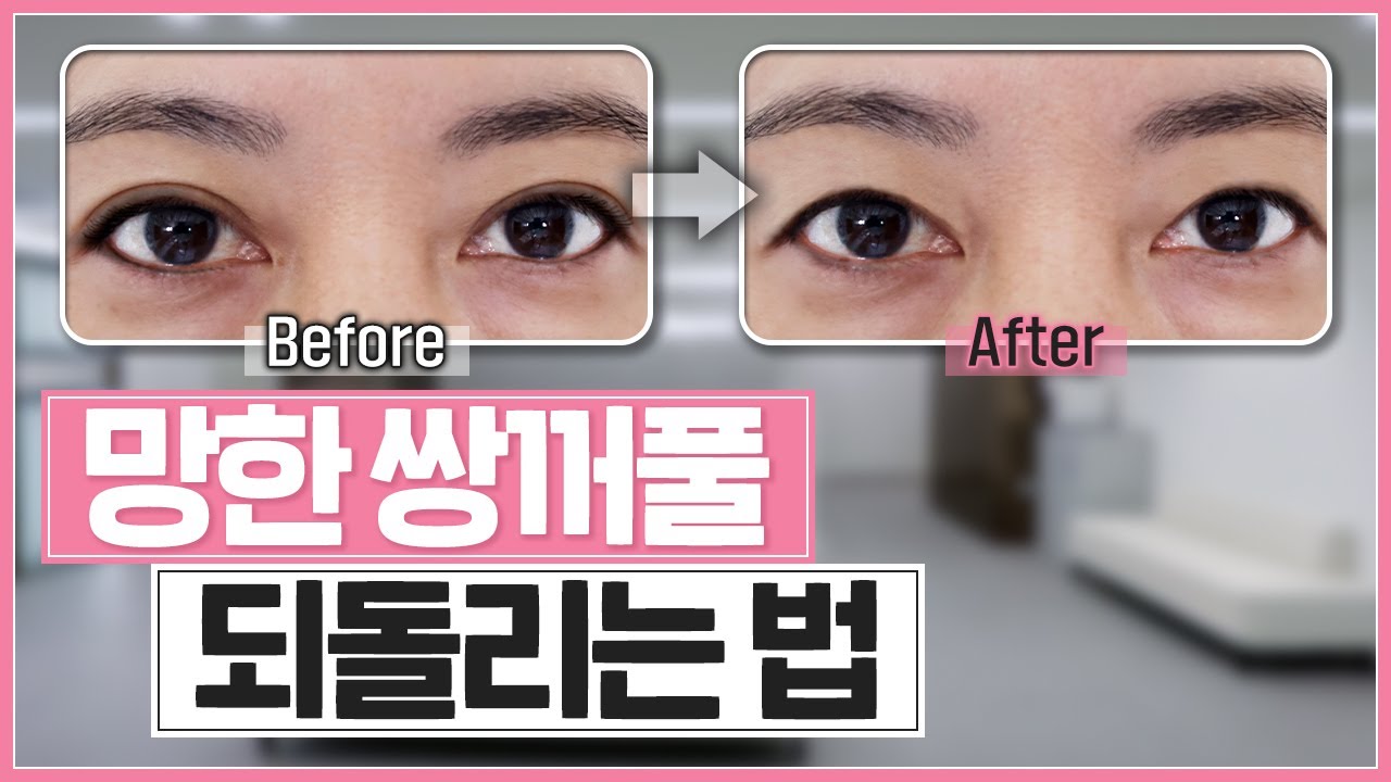 쌍꺼풀 수술 전으로 돌아가고 싶다면 주목! 📢｜피부 절제 없는 